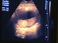 Baby 2D echo 20 weken