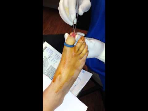 how to cure mma damaged nails