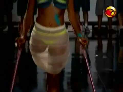 Brazilian RAK-Amputee Model on Crutches Showing a Perfectly Shaped Stump