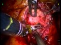 Robotic-Assisted Laparoscopic Radical Prostatectomy (RALRP) - Bladder Neck Protection Robotic-Assisted Laparoscopic Radical Prostatectomy (RALRP) - Bladder Neck Protection