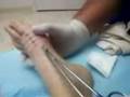 videos de Foot surgery