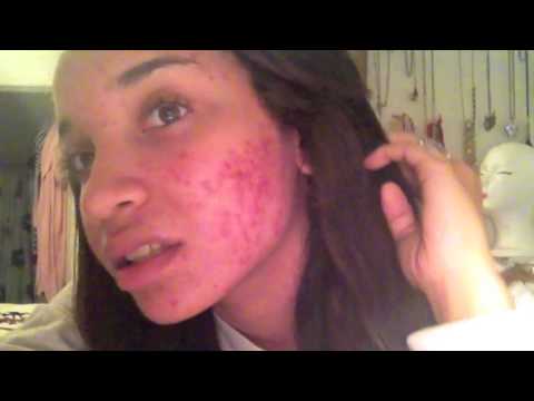 SKIN| My Acne Journey