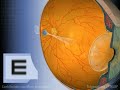 Astigmatismo