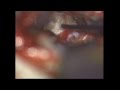 Neuralgia of Trigeminal Nerve - Microvascular Decompression Neuralgia of Trigeminal Nerve - Microvascular Decompression