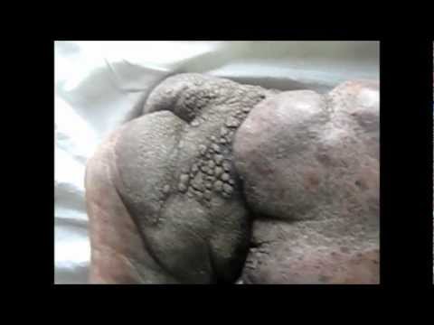 how to treat elephantiasis