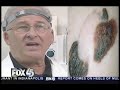 Monte Meltzer, Dermatologist, Talks About Skin Cancer Monte Meltzer, Dermatologist, Talks About Skin Cancer