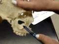 Openings to Paranasal Sinuses