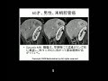 60M CCC peripheral type  This video includes MRI, CT, angiography. Angiography