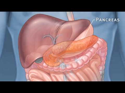 how to qualify for a pancreas transplant