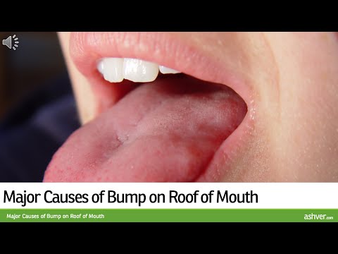 how to relieve roof of mouth pain