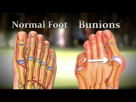 bunion