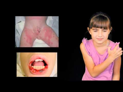 how to treat erythema multiforme