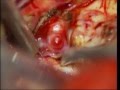 Brain aneurysm middle cerebral artery bifurcation aneurysm microsurgery-dr suresh dugani/HUBLI/INDIA