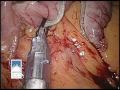 Laparoscopic Sleeve Gastrectomy with Narration