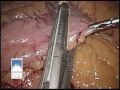 Laparoscopic Sleeve Gastrectomy with Narration
