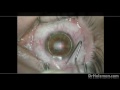 LASIK in Virginia & Washing DC - Before, During & After