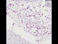 Histopathology Brain, cerebrum--Cryptococcosis (PAS stain) Cryptococcosis
