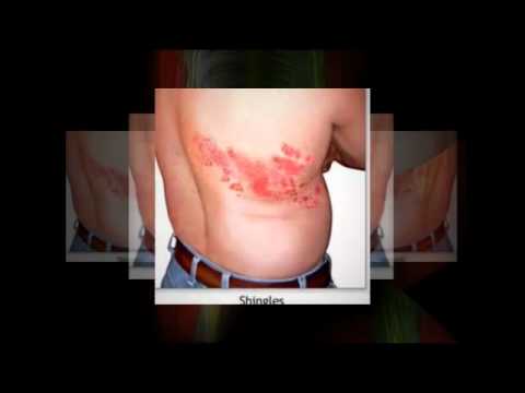 how to assess herpes zoster
