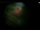 Laser Photocoagulation - doing it again