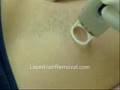 Male Laser Hair removal 
