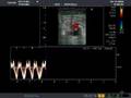 Venous flow in patient with central venous hypertension