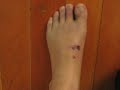 Sausage Foot