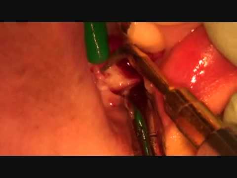 how to cure dry socket