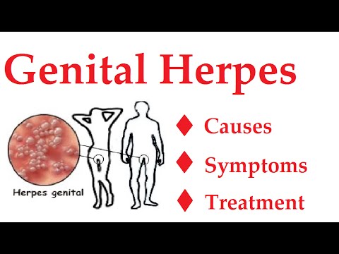 how to relieve genital herpes