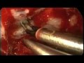 Endoscopic Endonasal Transplanum Transtuberculum Approach for Retrochiasmatic Craniopharyngioma
