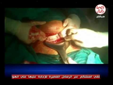اللي عايزه تولد قيصريه لازم تشوف الفيديو ده