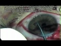 Gusano en el ojo - Tabasco Mexico - Worm in the eye - Gnathostomiasis