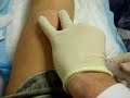 Knee Draining