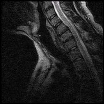 Herniated Disc In Neck. Herniated Disc, Pinched Nerve,