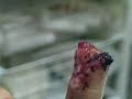 accident on a bmx-buzz finger loss crash accident on a bmx-buzz finger loss crash