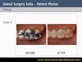 DENTAL FILLING SURGERY CURES TEETH CAVITIES.