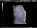 3D Sonogram