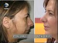 Burun Esteti�i �ncesi ve Sonras�