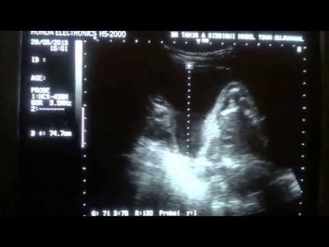 how to measure afi ultrasound