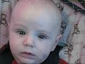 Miracle Poop Strain Forehead Marks