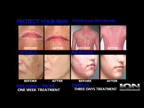 how to remove eczema