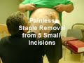 DrR Removes Staples 5 days After MGB