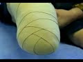 Meike Brouwer Rehab - stumps bandaging technique