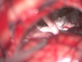 Epidermoid Tumor of Posterior Cranial Fossa