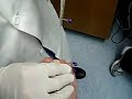 Toe Piercing Removal