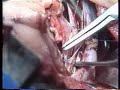 exeresis esofago cervical