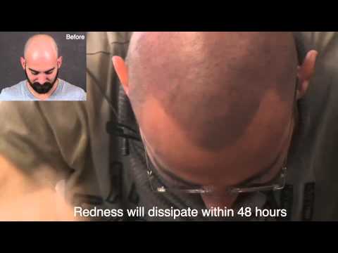how to cure hair loss