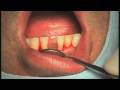intermezzo live surgery Implant placement part 1