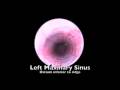 Balloon Dilation of Maxillary Sinus Balloon Dilation of Maxillary Sinus