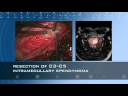 Treating Spinal Tumors with New Flexible Laser Fibers: Dr. Spetzler at the BNI