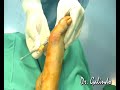 Juanetes.Hallux Valgus.Dr E G Andújar & Dr E Galindo Martens Juanetes.Hallux Valgus.Dr E G Andújar & Dr E Galindo Martens